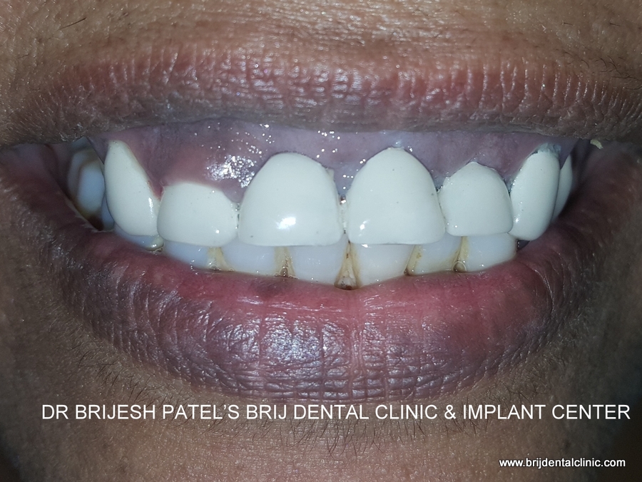 ceramic tooth crown cost in india