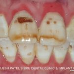 fluorosis teeth with weak tooth Structure