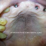 Upper Jaw Implants