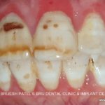 fluorosis teeth with weak tooth Structure