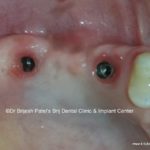 Dental Implant In Upper Maxillary Molars