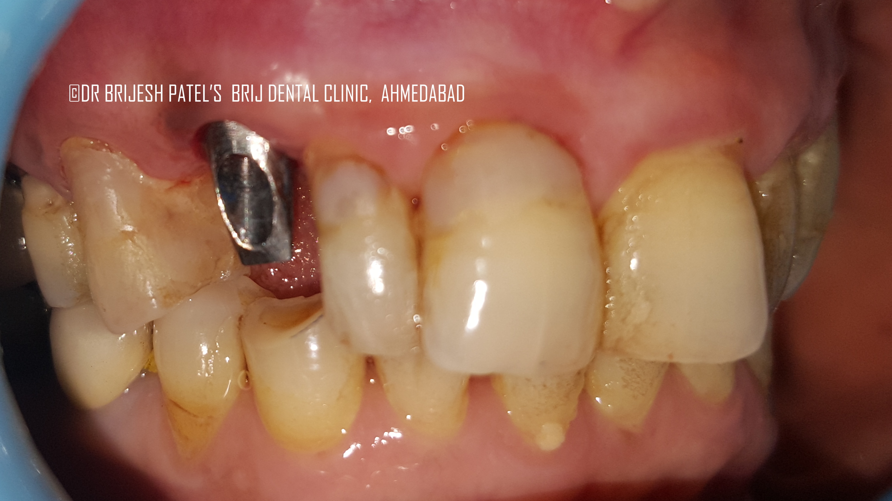 Cost of Dental Implants Ahmedabad India Best Dental Implant Clinic