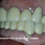 broken Ceramic Teeth Side view