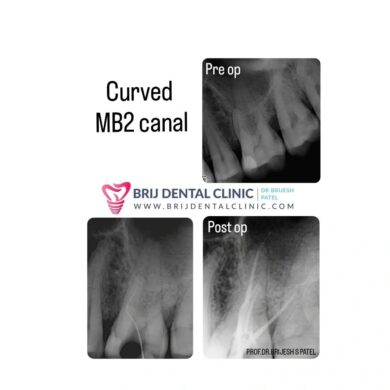 Curved Roots Rct Painless Single Sitting Root Canal Treatment ahmedabad | RCT Specialist