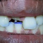 Old Broken Tooth With Failed Crown