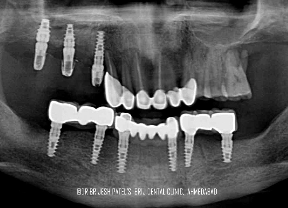 Full-Mouth-Implants-in opg xray