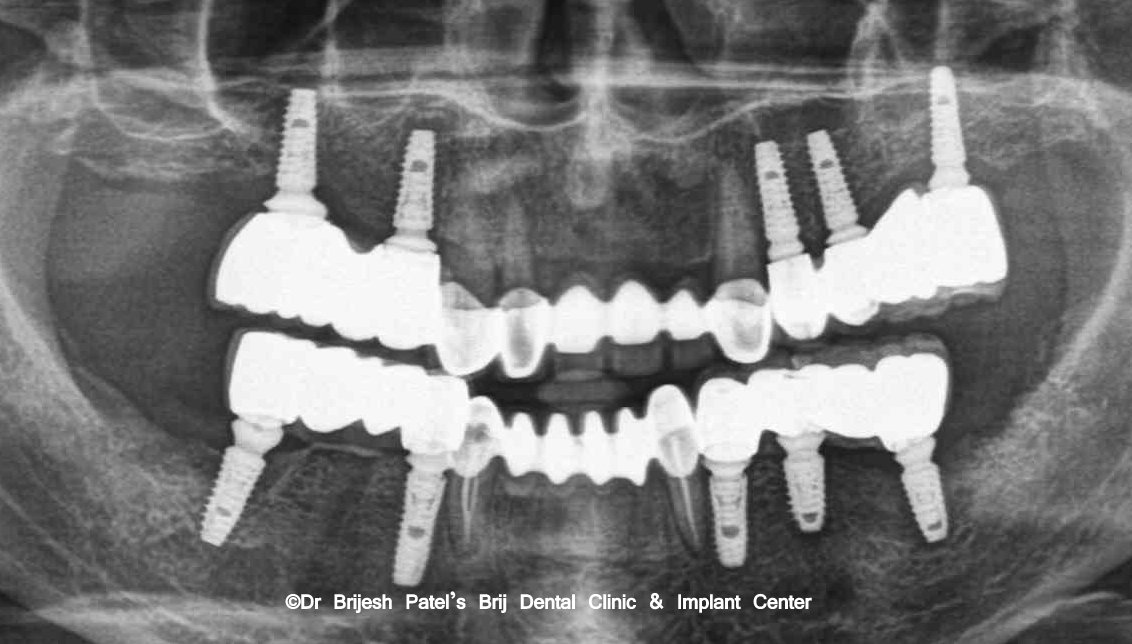 Full mouth Dentium dental Implants in OPG Xray