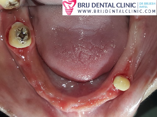 lower arch after extraction