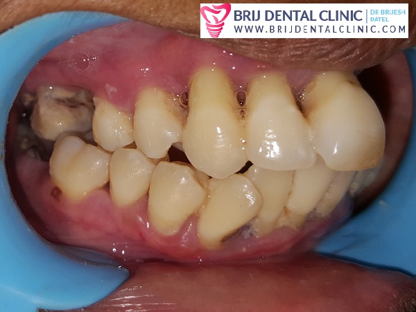 Pyorrhoea loose teeth treatment at best dental clinic ahmedabad