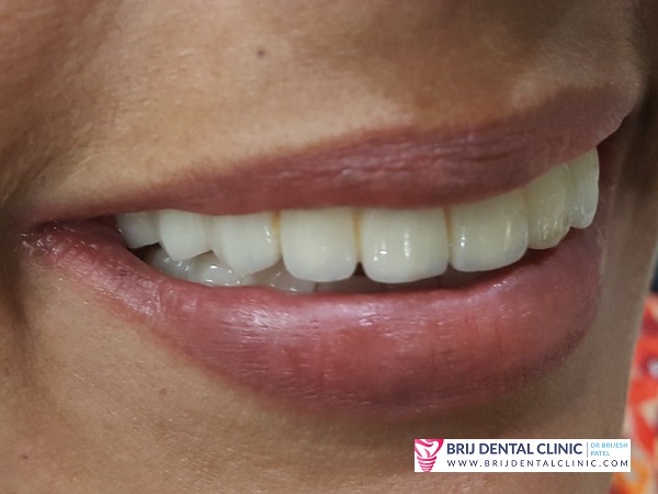 Smile after Full mouth ceramic Teeth on Dental Implants
