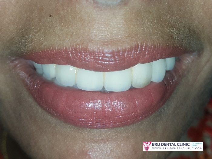 Smile makeover after implant treatment