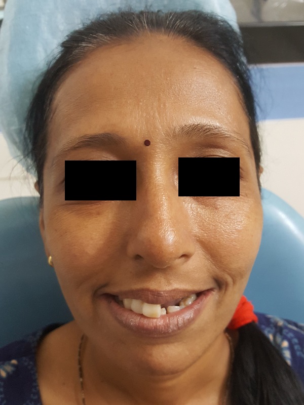 Before treatment face with missing teeth
