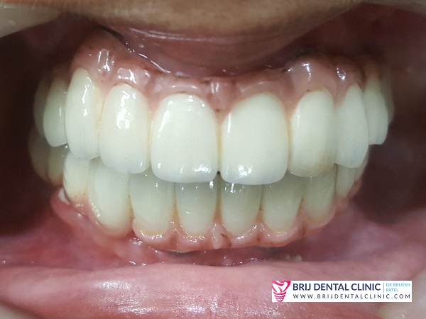 Ceramic Teeth Full Mouth Reconsturction by Best Dentist Dr Brijesh S Patel Ahmedabad