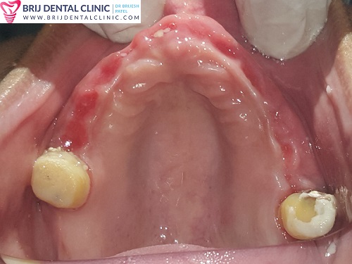 upper arch after extraction