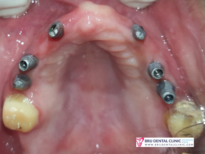 upper arch dental implants with implant abutment