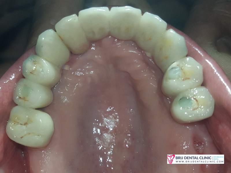 upper ceramic Teeth on dental implants