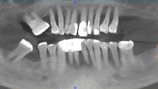 Weak loose Teeth in Xray OPG