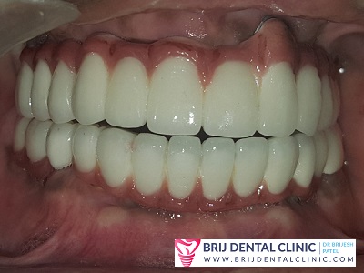 Smile makeover by Dental Implant by Dr Brijesh s Patel Best Dentist Ahmedabad