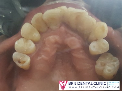 Loose Teeth treatment in ahmedabad