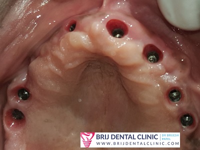 upper arch implants- implants in maxilla