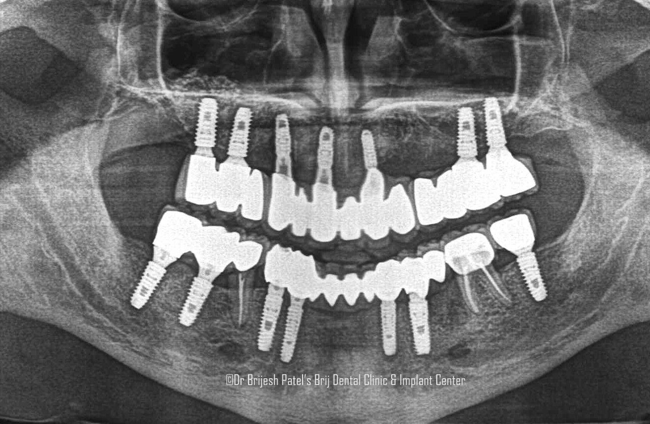 xray opg after fullmouth implants