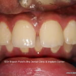 Gap and Procline Teeth Smile Before Treatment