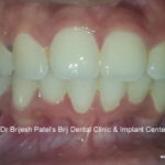 Smile and alignment correction after Braces