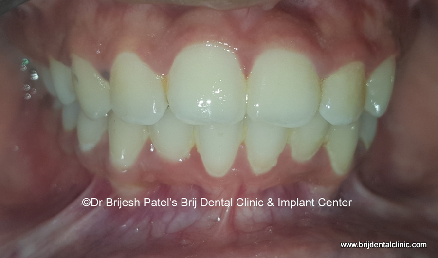 Smile and alignment correction after Braces