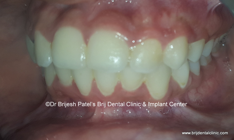 Correction of teeth after orthodontic braces