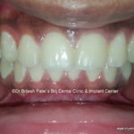Alignment Complete by Clear Aligner Treatment