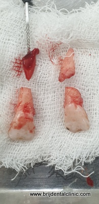 Fractured incisors after trauma