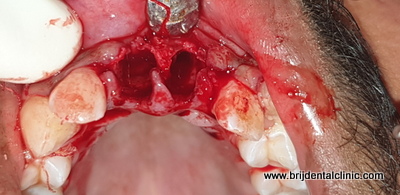 Atraumatic extraction of incisors