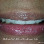 Beautiful Smile After Clear Aligner Treatment