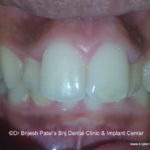 Buuny Procline Teeth