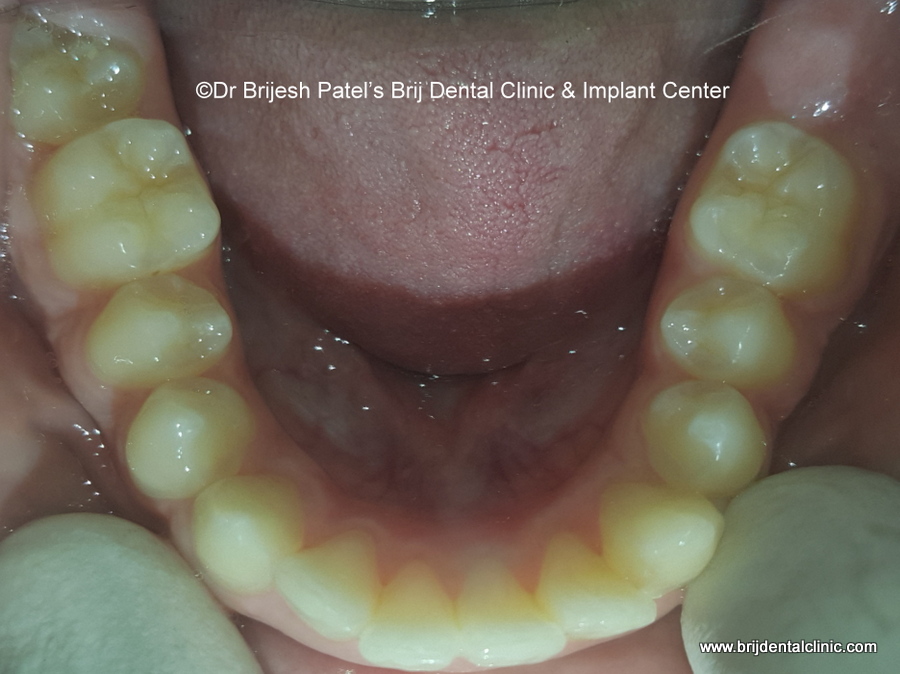 LOWER TEETH AFTER BRACES TREATMENT