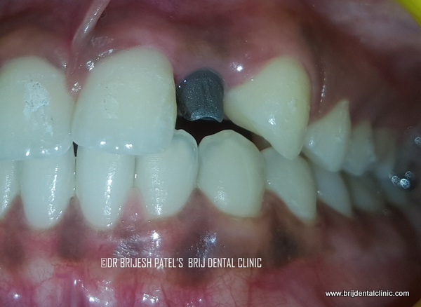 Implant Abutments fitted on left side missing lateral incisor