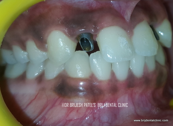 Implant Abutments fitted on Rt side missing lateral incisor