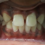 Missing Lateral Incisor & Gap Teeth