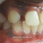 pre op rt side view of missing lateral incisor