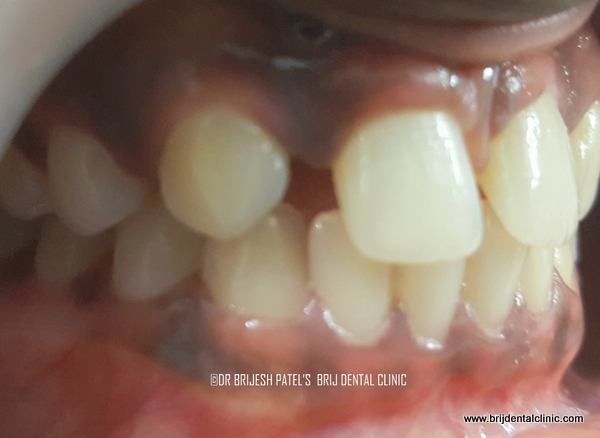 pre op rt side view of missing lateral incisor