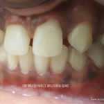 Preop sideview of gap teeth