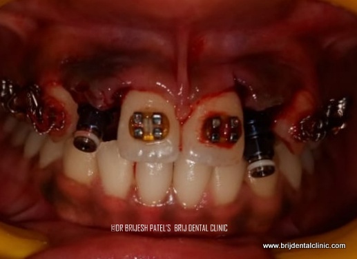Implant position in Lateral incisor