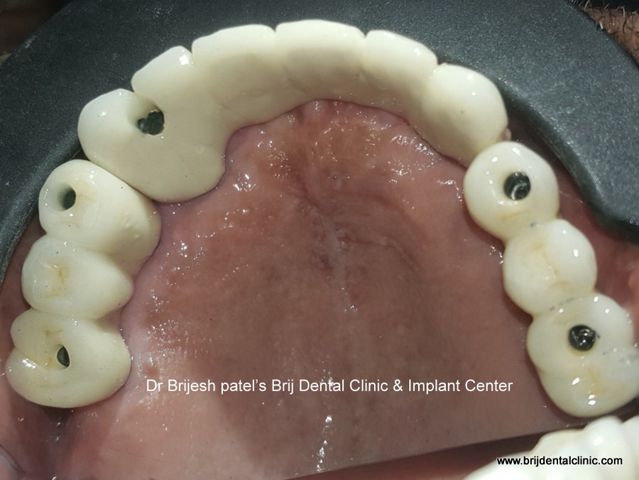Full Ceramic Teeth in Maxilla on Implants