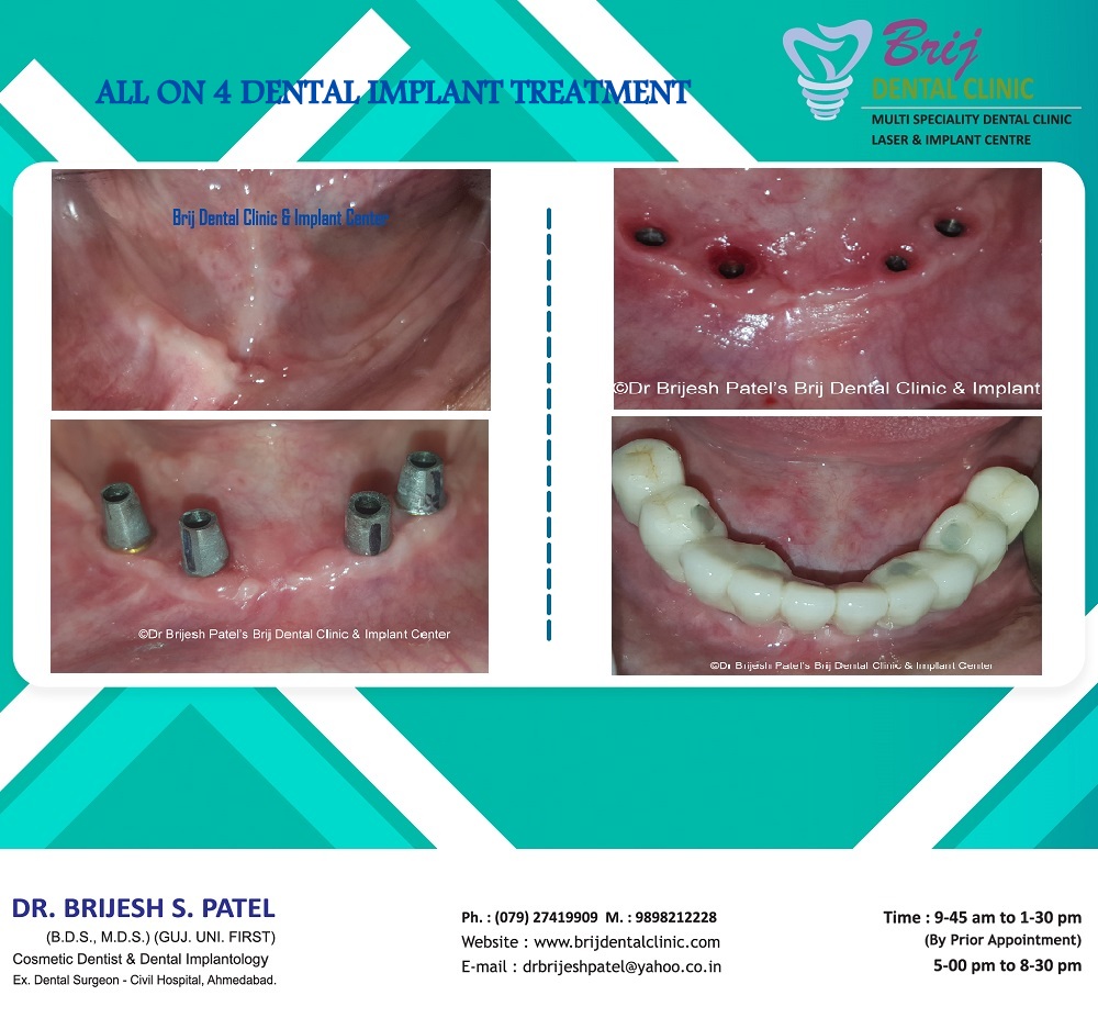 All on 4 Dental Implant Treatment @ Brij Dental Clinic