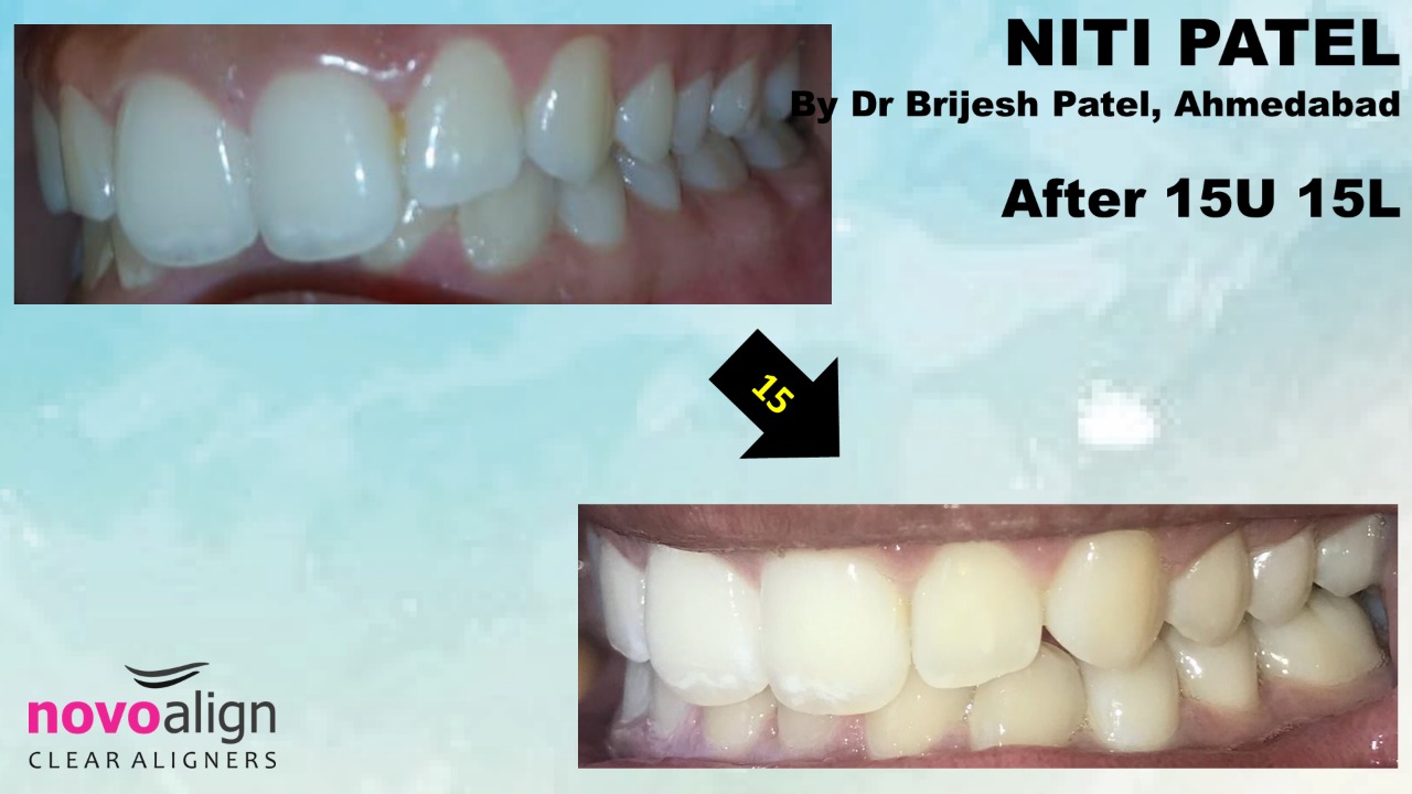 Deep Bite correction with Clear Aligner