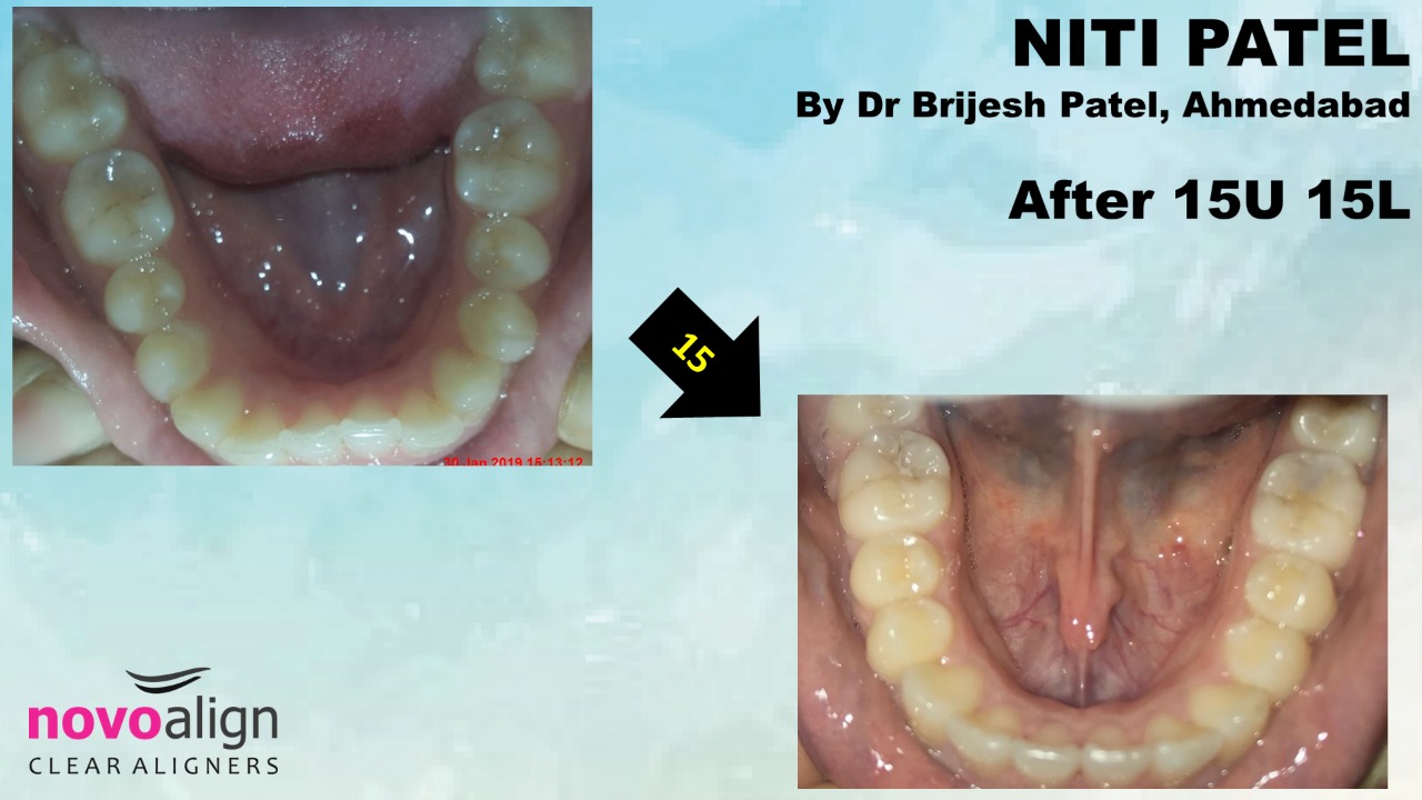 Lower crowding correction with Clear Aligner