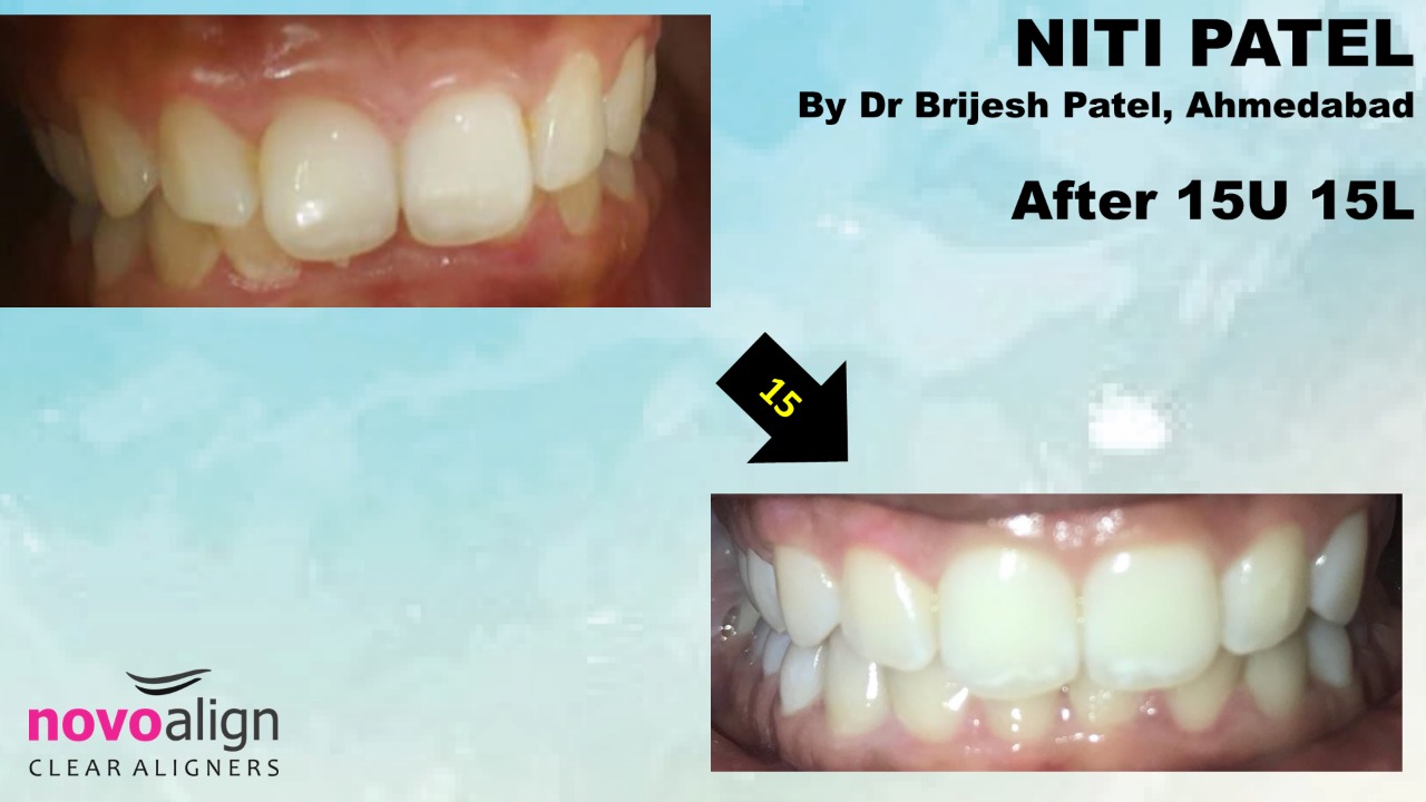 Smile and bite correction with clear aligner