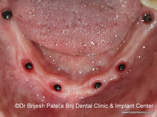 After Healing Six Dental Implants Lower jaw