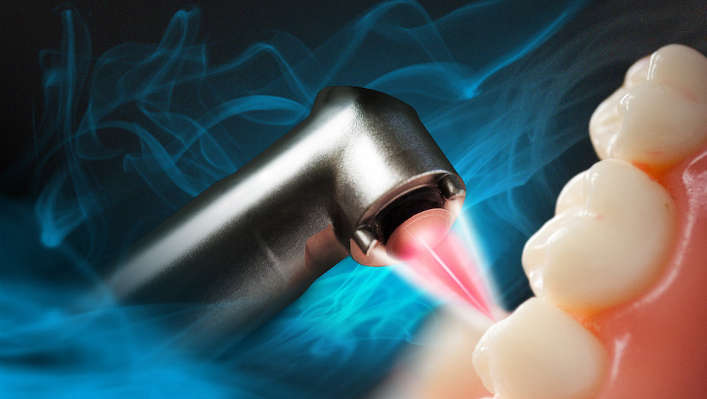Advance Laser Dental Treatment