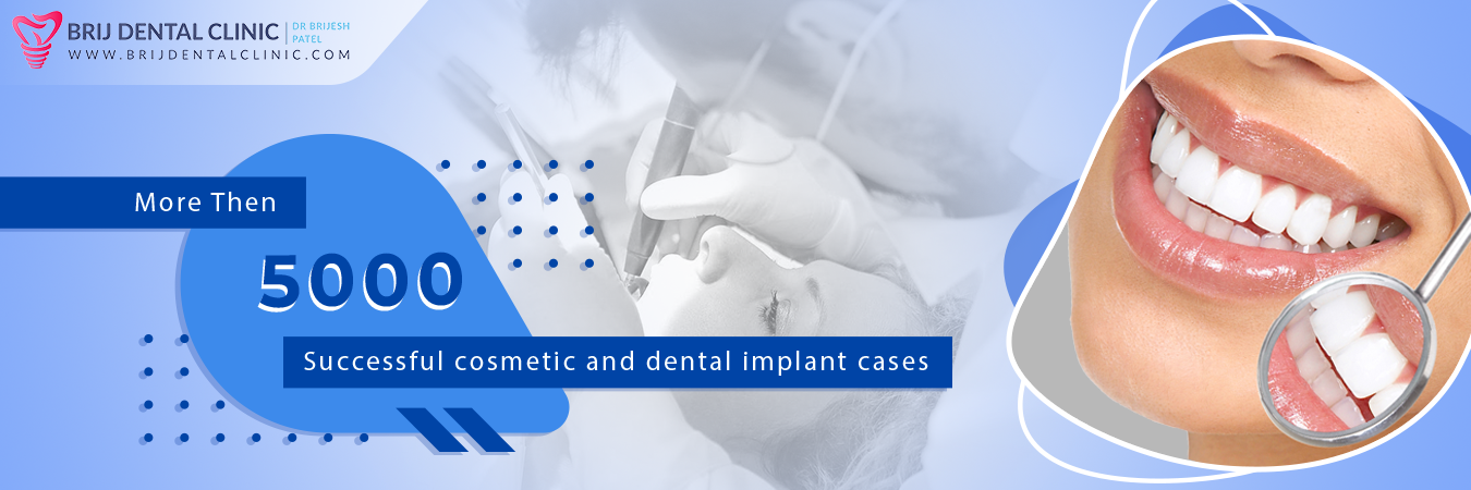 More than 5000 successful Dental Implant and cosmetic dentistry cases at Brij Dental Clinic Ahmedabad.